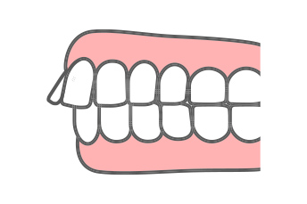 上顎前突（出っ歯）の治療例